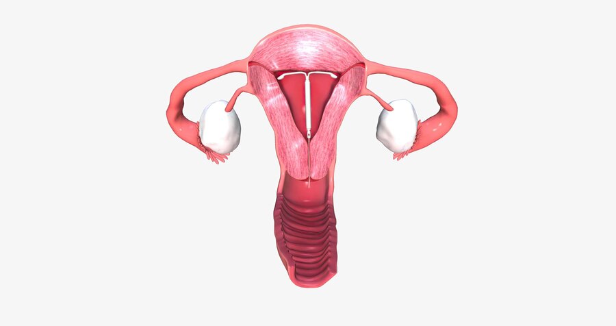 Mirena IUD